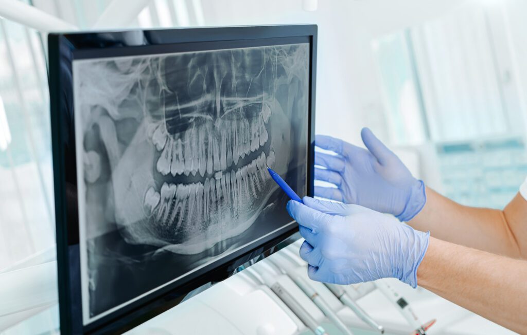 Replace missing teeth with dental implants in Lewisville.